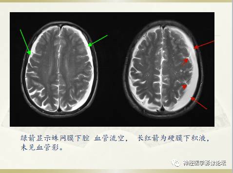 硬膜下积液与蛛网膜下腔间隙增宽鉴别 硬膜下积液与蛛网膜下腔间隙增宽鉴别