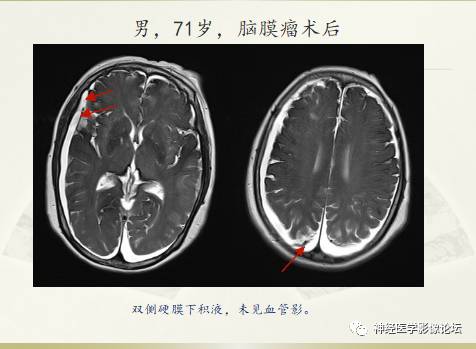 硬膜下积液与蛛网膜下腔间隙增宽鉴别 硬膜下积液与蛛网膜下腔间隙增宽鉴别