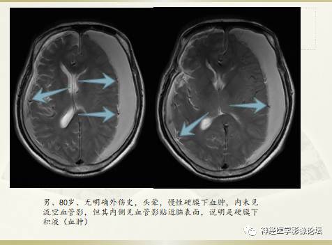 硬膜下积液与蛛网膜下腔间隙增宽鉴别 硬膜下积液与蛛网膜下腔间隙增宽鉴别