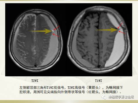 硬膜下积液与蛛网膜下腔间隙增宽鉴别 硬膜下积液与蛛网膜下腔间隙增宽鉴别
