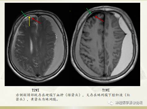 硬膜下积液与蛛网膜下腔间隙增宽鉴别 硬膜下积液与蛛网膜下腔间隙增宽鉴别