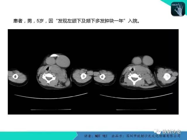【病例】霍奇金淋巴瘤1例CT影像表现