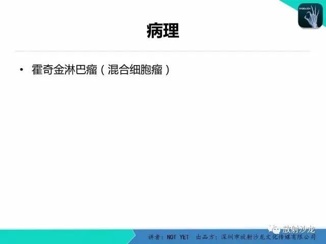 【病例】霍奇金淋巴瘤1例CT影像表现