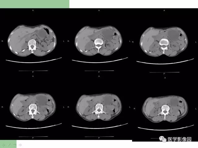 【病例】胰腺导管腺癌1例CT影像表现