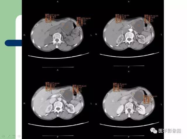 【病例】胰腺导管腺癌1例CT影像表现