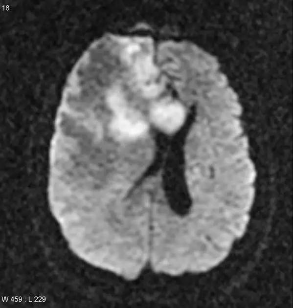 【病例】(胼胝体)原发性中枢神经系统淋巴瘤1例MR 【病例】(胼胝体)原发性中枢神经系统淋巴瘤1例MR