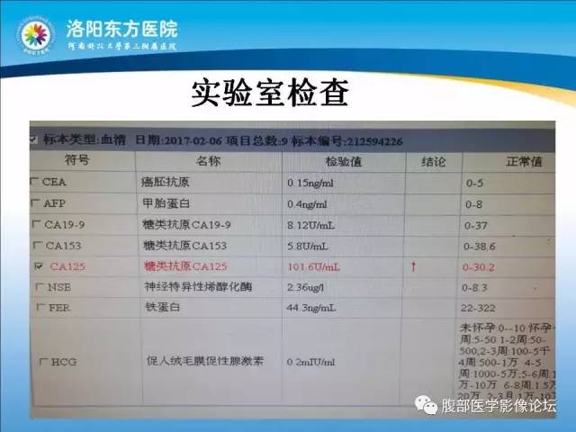 【病例】胃淋巴瘤1例CT 【病例】胃淋巴瘤1例CT