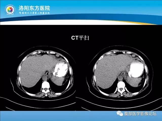 【病例】胃淋巴瘤1例CT 【病例】胃淋巴瘤1例CT