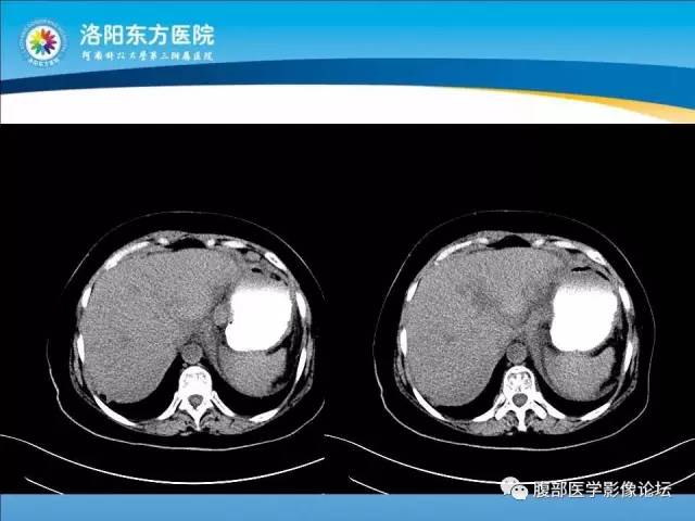 【病例】胃淋巴瘤1例CT 【病例】胃淋巴瘤1例CT