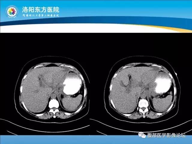 【病例】胃淋巴瘤1例CT 【病例】胃淋巴瘤1例CT