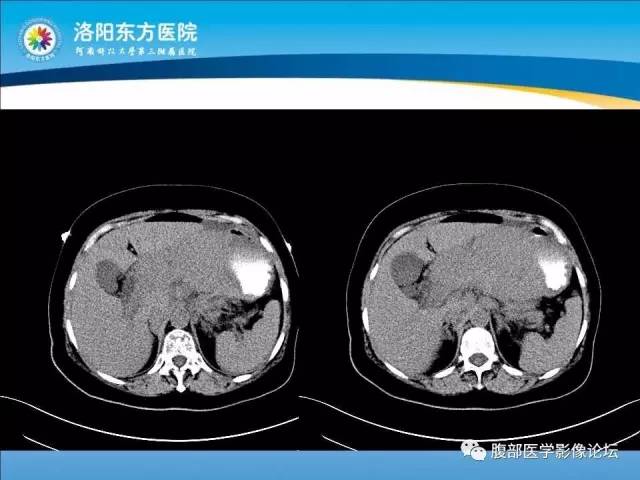 【病例】胃淋巴瘤1例CT 【病例】胃淋巴瘤1例CT