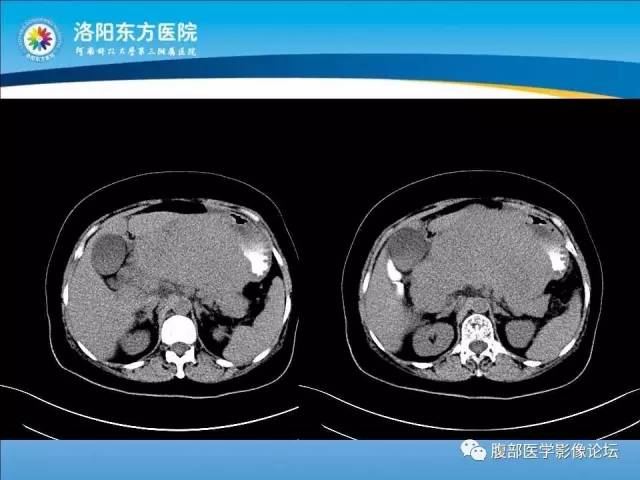 【病例】胃淋巴瘤1例CT 【病例】胃淋巴瘤1例CT