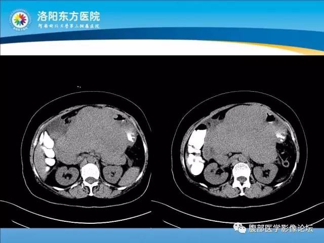 【病例】胃淋巴瘤1例CT 【病例】胃淋巴瘤1例CT