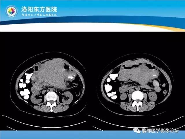 【病例】胃淋巴瘤1例CT 【病例】胃淋巴瘤1例CT