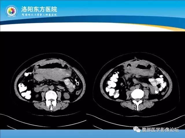 【病例】胃淋巴瘤1例CT 【病例】胃淋巴瘤1例CT