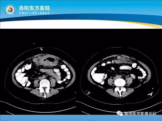 【病例】胃淋巴瘤1例CT 【病例】胃淋巴瘤1例CT