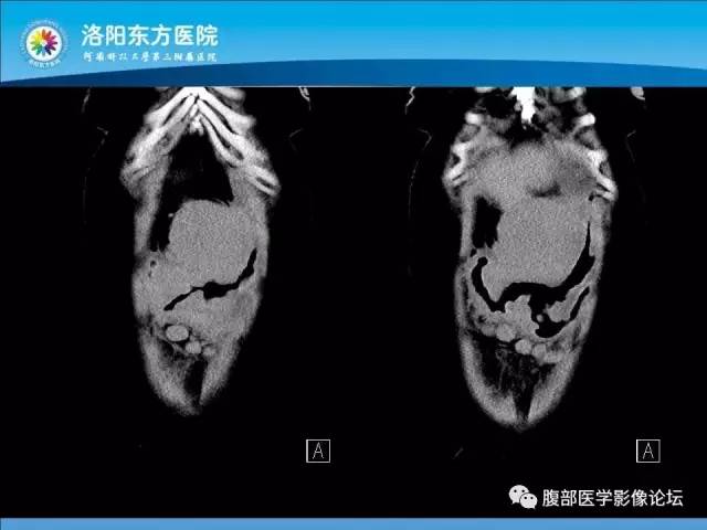 【病例】胃淋巴瘤1例CT 【病例】胃淋巴瘤1例CT