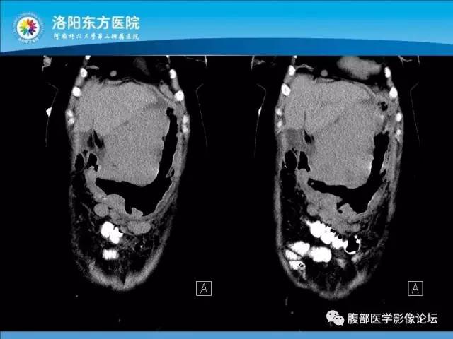 【病例】胃淋巴瘤1例CT 【病例】胃淋巴瘤1例CT