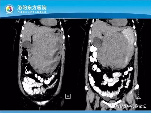 【病例】胃淋巴瘤1例CT 【病例】胃淋巴瘤1例CT