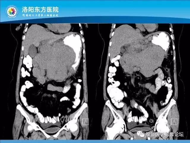 【病例】胃淋巴瘤1例CT 【病例】胃淋巴瘤1例CT