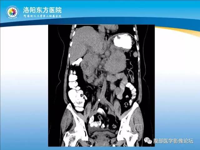 【病例】胃淋巴瘤1例CT 【病例】胃淋巴瘤1例CT