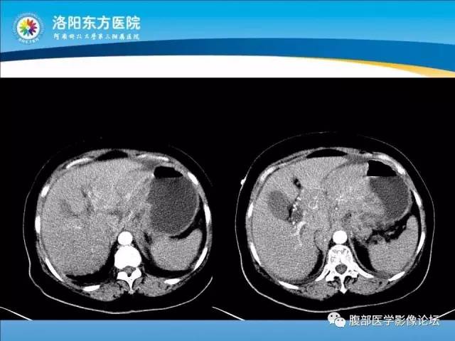 【病例】胃淋巴瘤1例CT 【病例】胃淋巴瘤1例CT