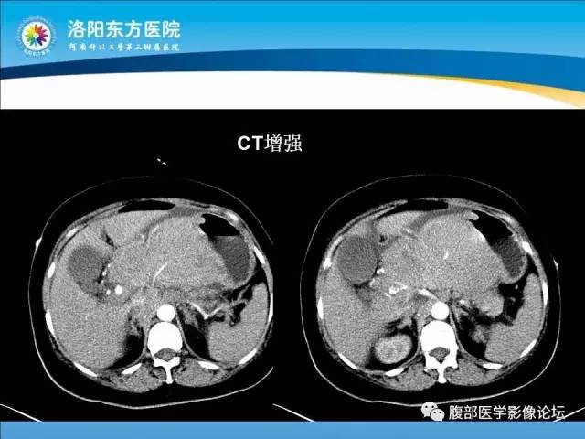 【病例】胃淋巴瘤1例CT 【病例】胃淋巴瘤1例CT