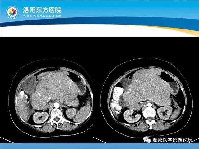 【病例】胃淋巴瘤1例CT 【病例】胃淋巴瘤1例CT