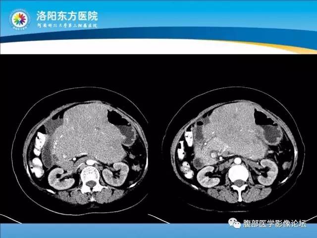 【病例】胃淋巴瘤1例CT 【病例】胃淋巴瘤1例CT