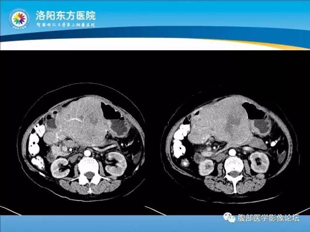 【病例】胃淋巴瘤1例CT 【病例】胃淋巴瘤1例CT
