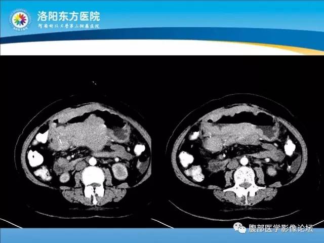 【病例】胃淋巴瘤1例CT 【病例】胃淋巴瘤1例CT