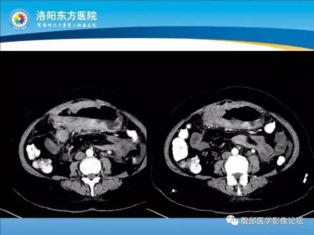 【病例】胃淋巴瘤1例CT 【病例】胃淋巴瘤1例CT