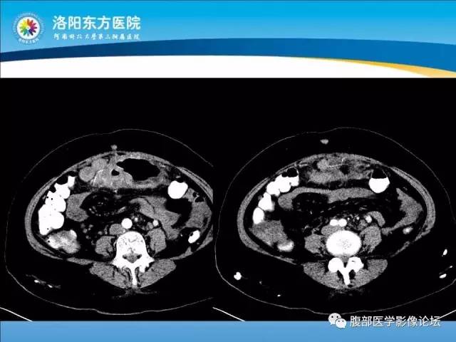 【病例】胃淋巴瘤1例CT 【病例】胃淋巴瘤1例CT