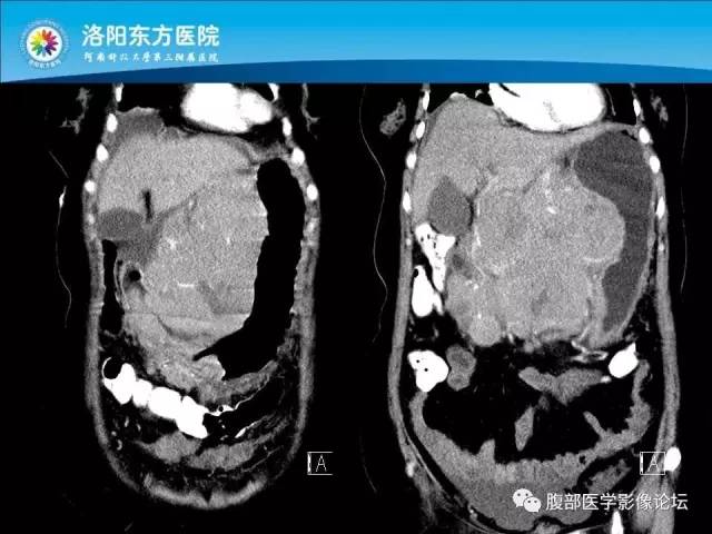 【病例】胃淋巴瘤1例CT 【病例】胃淋巴瘤1例CT