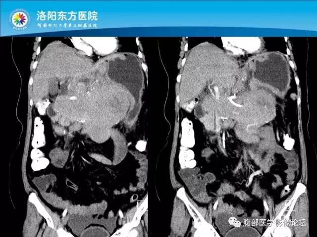 【病例】胃淋巴瘤1例CT 【病例】胃淋巴瘤1例CT