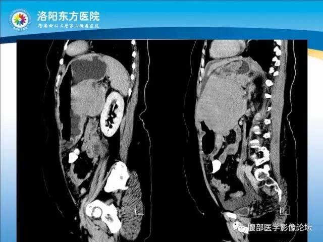 【病例】胃淋巴瘤1例CT 【病例】胃淋巴瘤1例CT