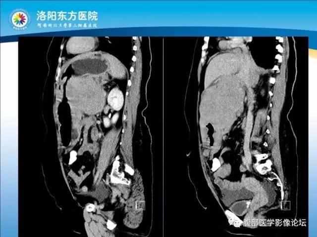 【病例】胃淋巴瘤1例CT 【病例】胃淋巴瘤1例CT