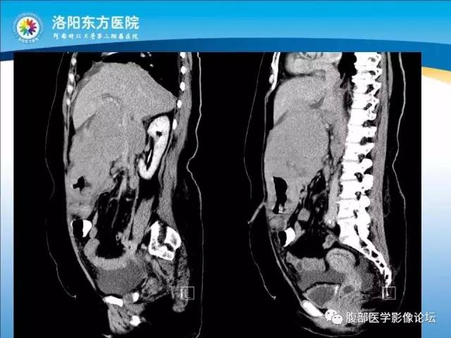 【病例】胃淋巴瘤1例CT 【病例】胃淋巴瘤1例CT