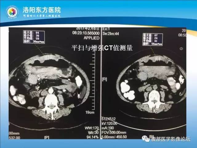 【病例】胃淋巴瘤1例CT 【病例】胃淋巴瘤1例CT