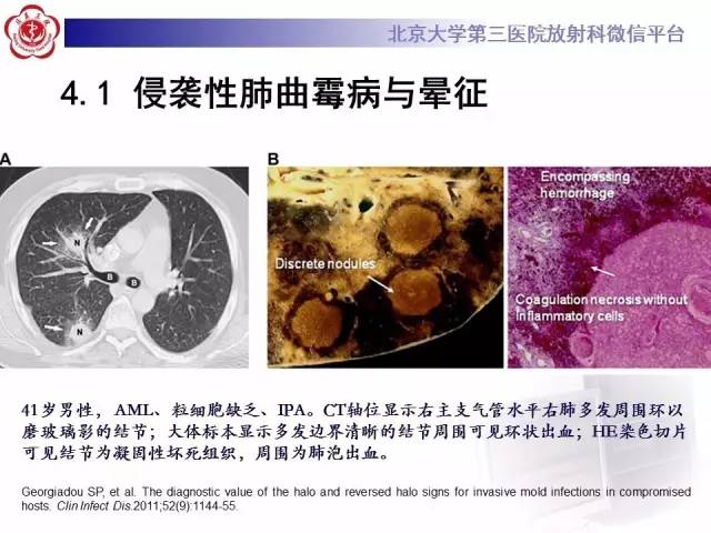 【PPT】晕征与反晕征