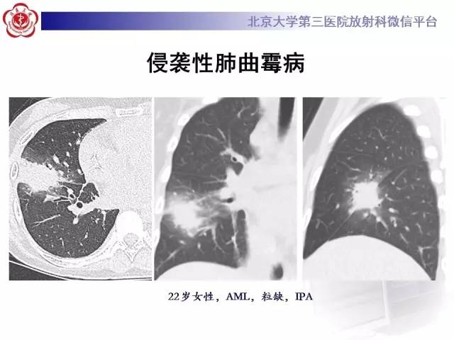 【PPT】晕征与反晕征