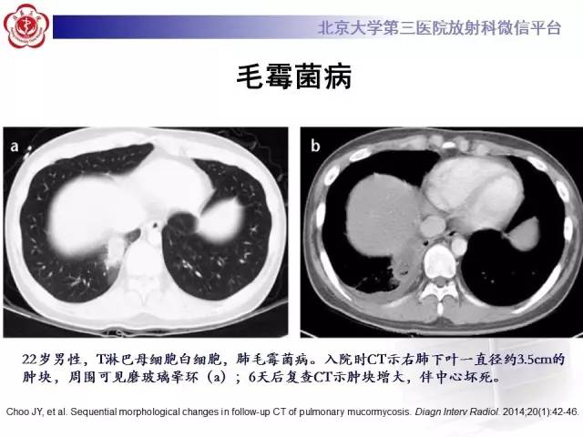【PPT】晕征与反晕征