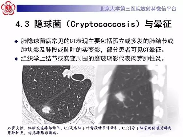 【PPT】晕征与反晕征
