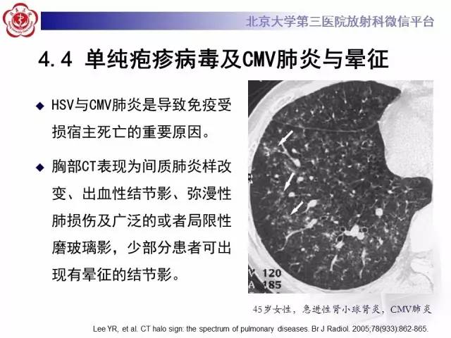 【PPT】晕征与反晕征