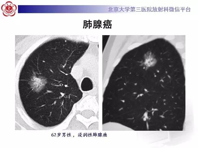 【PPT】晕征与反晕征