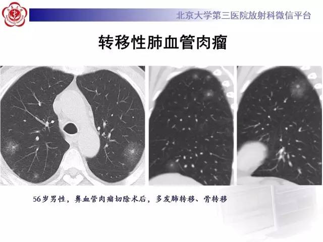 【PPT】晕征与反晕征