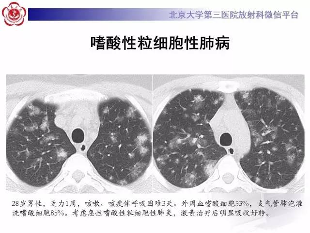 【PPT】晕征与反晕征
