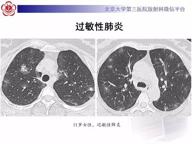 【PPT】晕征与反晕征