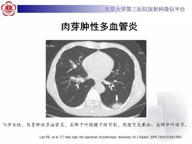 【PPT】晕征与反晕征