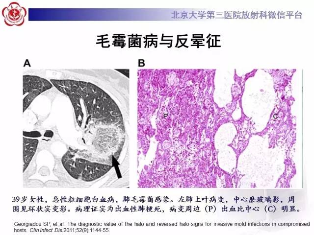 【PPT】晕征与反晕征
